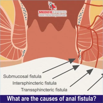 Causes of anal fistula