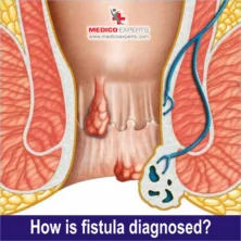 how fistula is diagnosed? how fistula is diagnosed?
