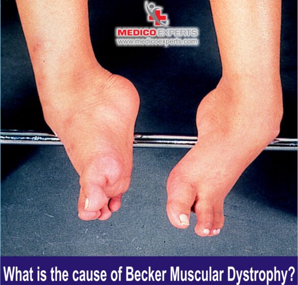 Becker muscular dystrophy causes Becker muscular dystrophy causes