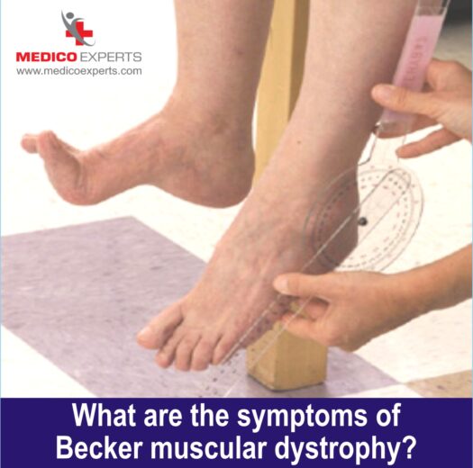 Becker muscular dystrophy symptoms Becker muscular dystrophy symptoms