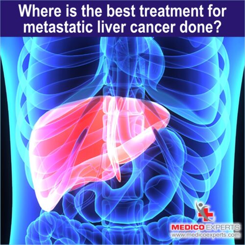 Metastatic Liver Cancer Treatment tumor board approach Metastatic Liver Cancer Treatment tumor board approach