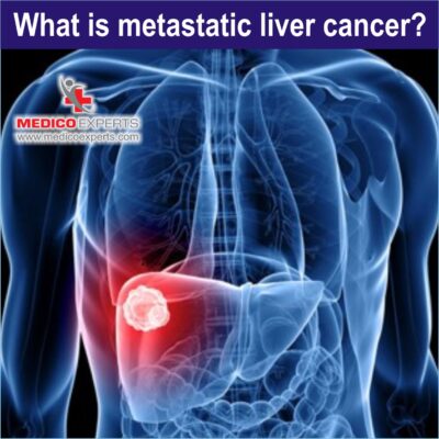 What is Metastatic Liver Cancer What is Metastatic Liver Cancer