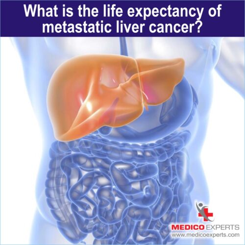 What is the life expectancy of Metastatic Liver Cancer What is the life expectancy of Metastatic Liver Cancer, Metastatic Liver Cancer treatment