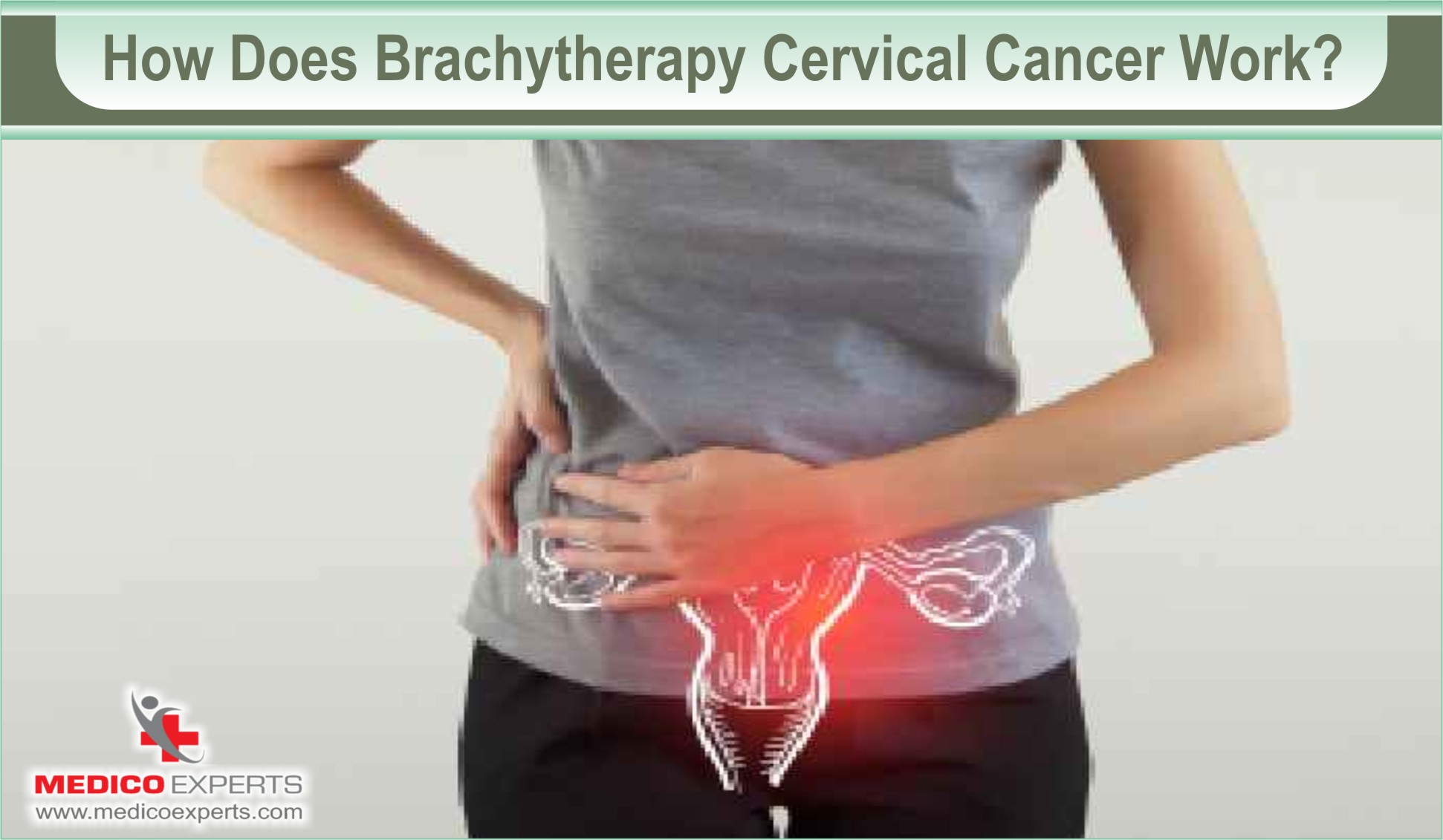 Effectiveness of Brachytherapy for Cervical Cancer