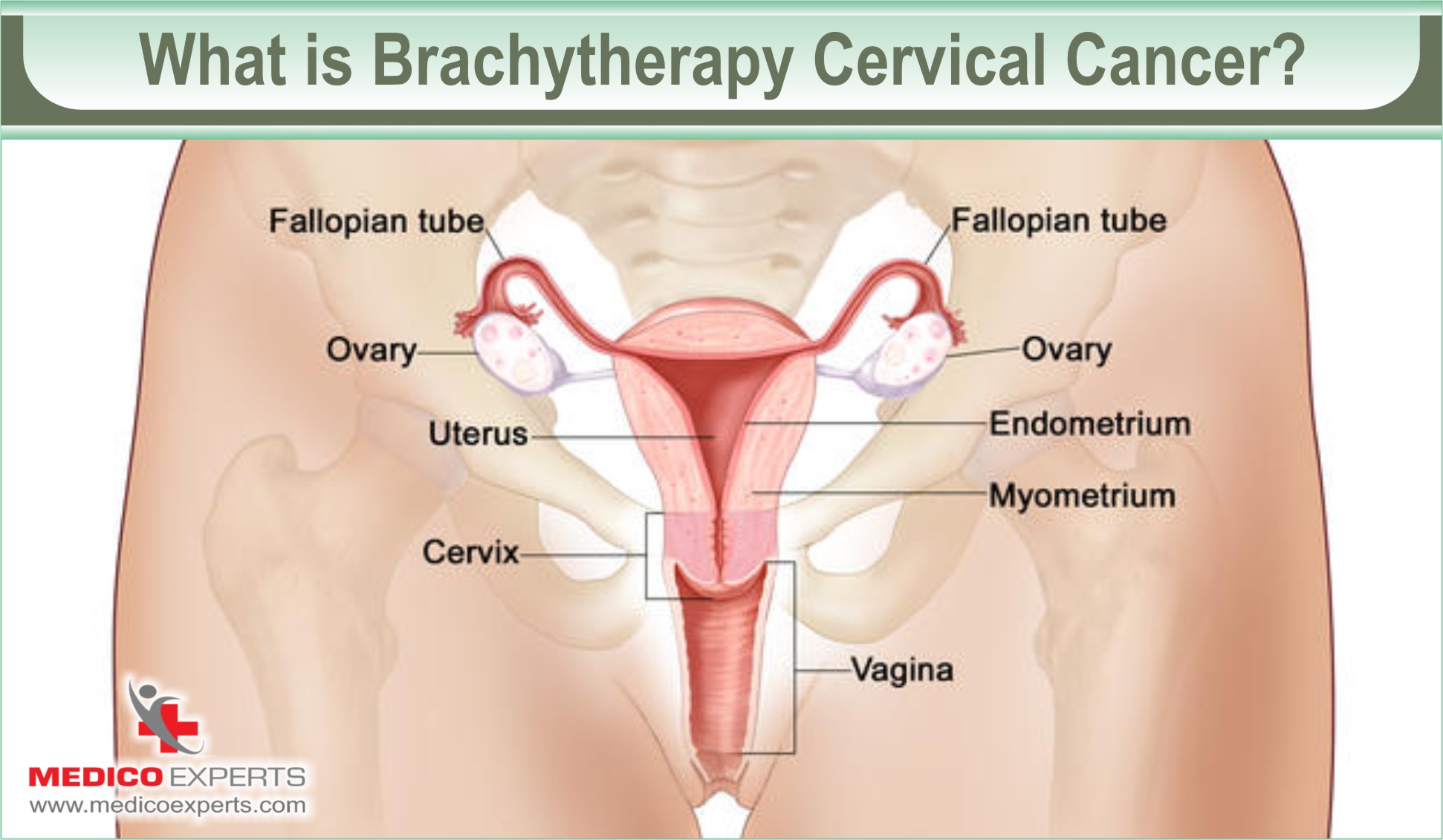 Effectiveness of Brachytherapy for Cervical Cancer