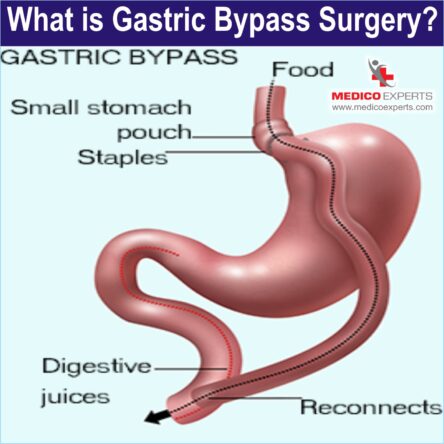 Gastric Bypass Surgery in nigeria Gastric Bypass Surgery in nigeria