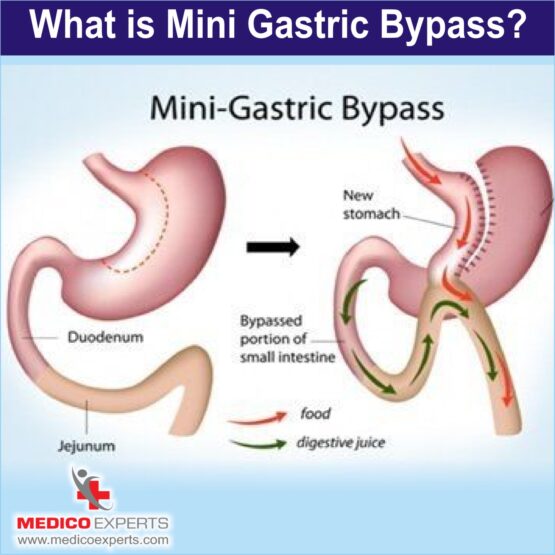 Mini Gastric Bypass Surgery Mini Gastric Bypass Surgery