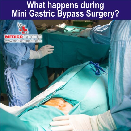 Mini Gastric Bypass Surgery Mini Gastric Bypass Surgery