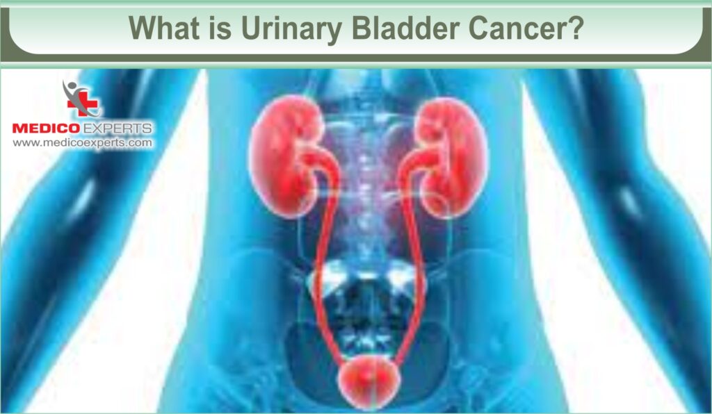 is urinary bladder cancer curable