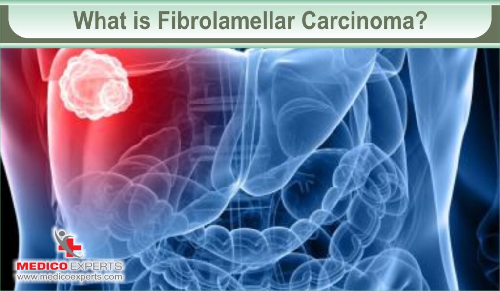 fibrolamellar carcinoma