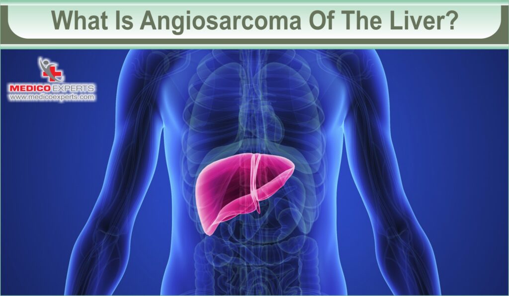 angiosarcoma of liver