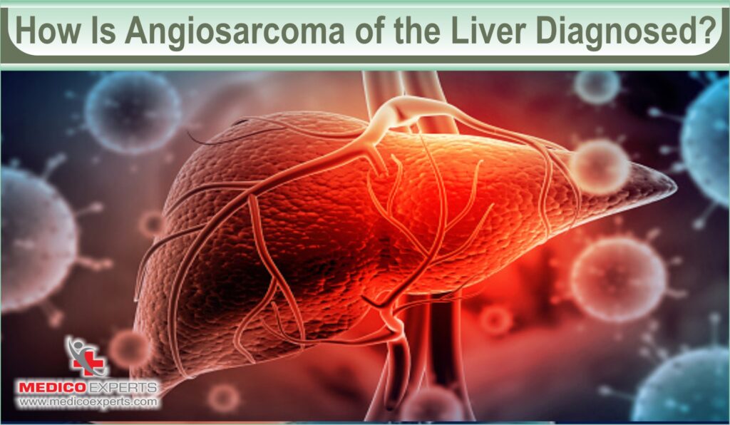 Symptoms Of Angiosarcoma _ Cardiac angiosarcoma: A diagnostic and ...