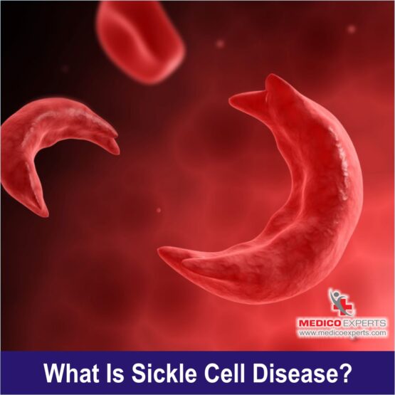 what is Sickle Cell Disease What is Sickle Cell Disease