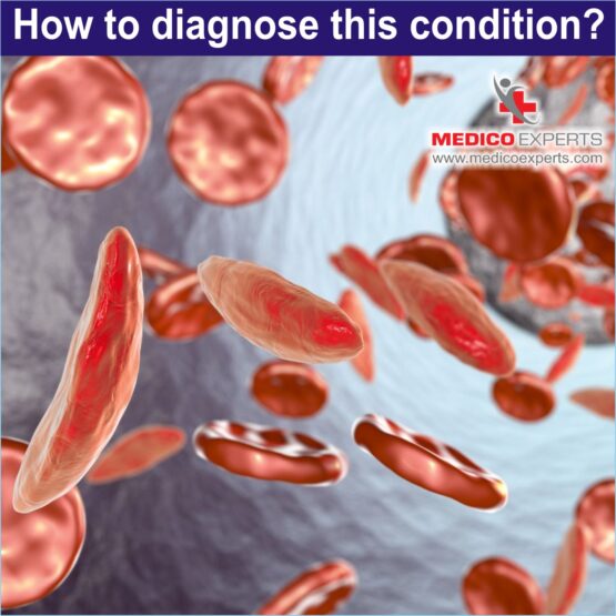 Sickle Cell Disease Sickle Cell Disease