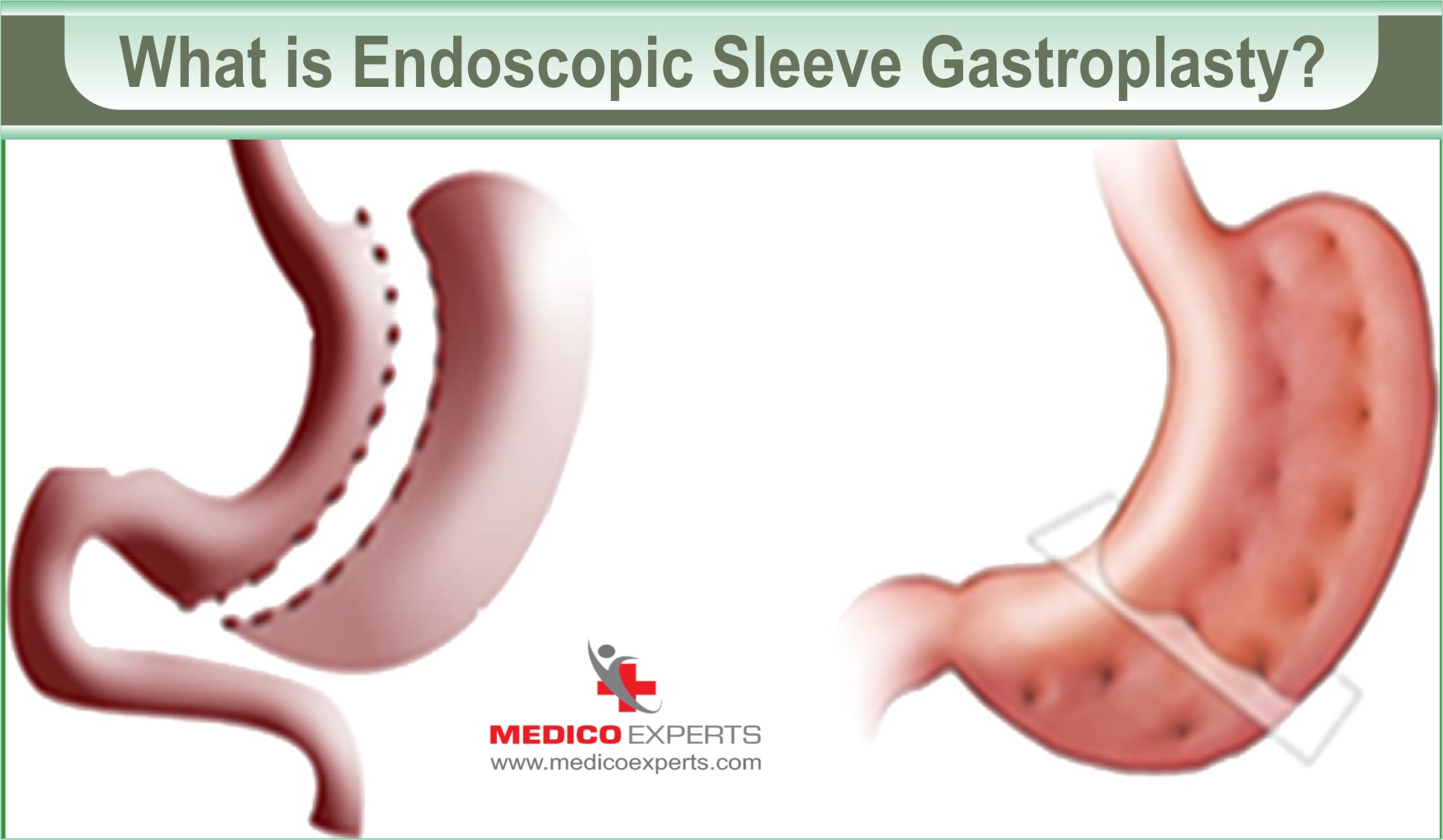Endoscopic Sleeve Gastroplasty for weight Loss