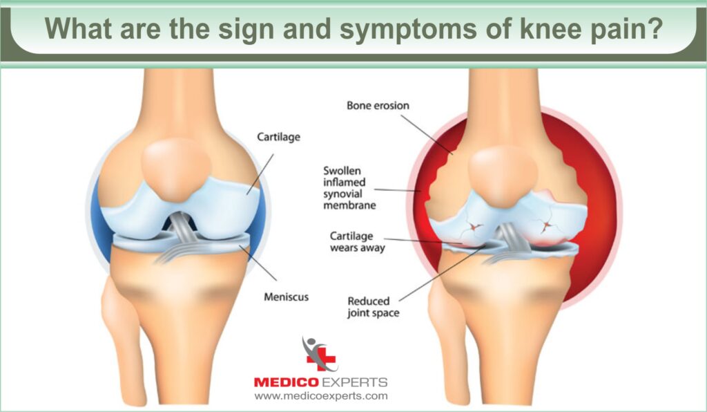 Understanding Knee Pain: From Suffering to Thriving 4 signs and symptoms of knee pain