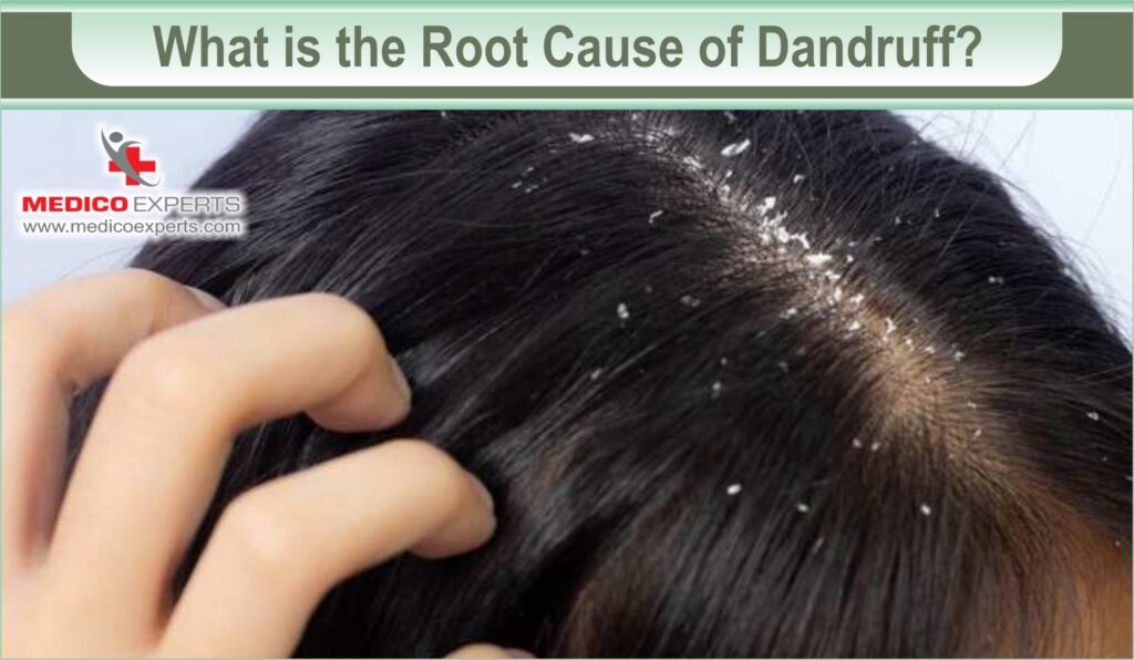 ayurvedic treatment for dandruff