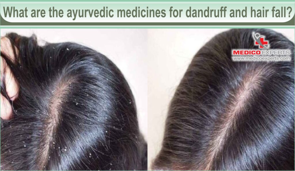 Ayurvedic medicine for  dandruff and hairfall