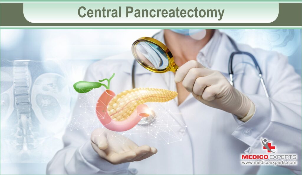 Central pancreatectomy