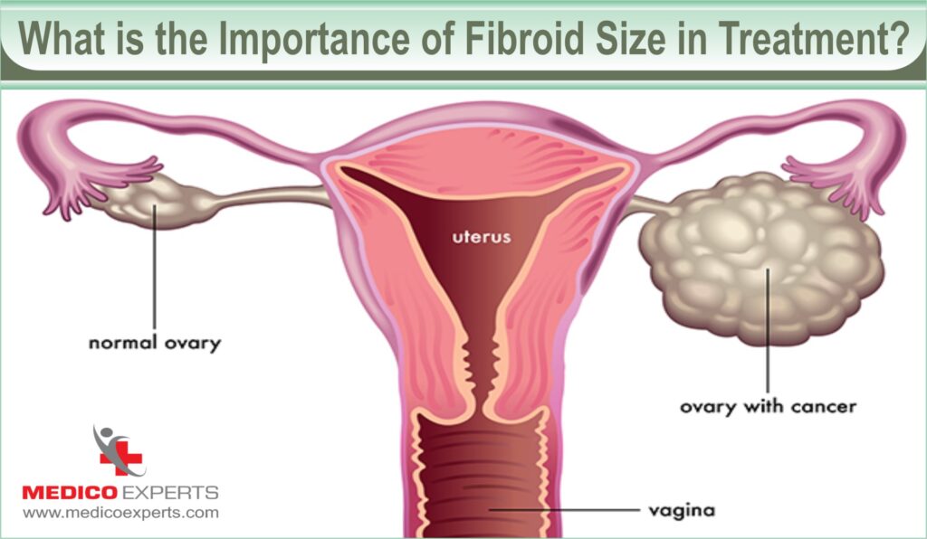 importance of fibroid size in treatment