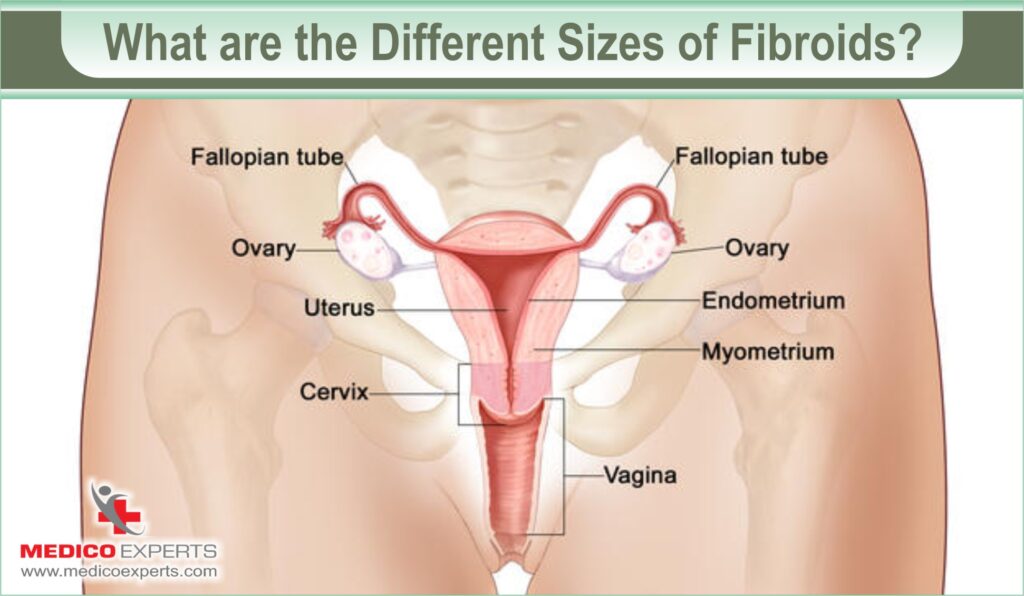 different size of fibroids 