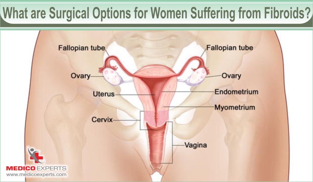 What are Surgical Options for Women Suffering from Fibroids