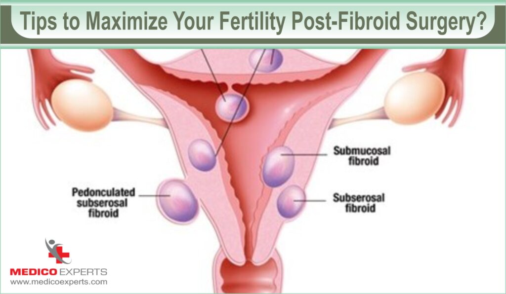 Tips to Maximize Your Fertility Post-Fibroid Surgery, what are the chances of getting pregnant after fibroid surgery