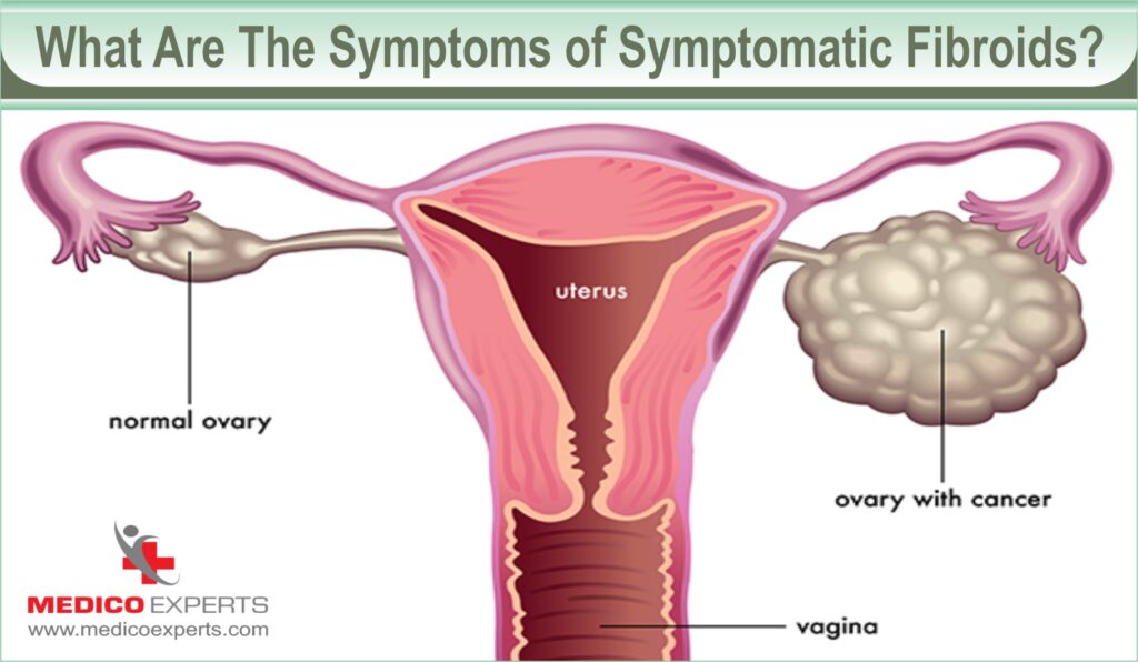 symptoms of symptomatic fibroids