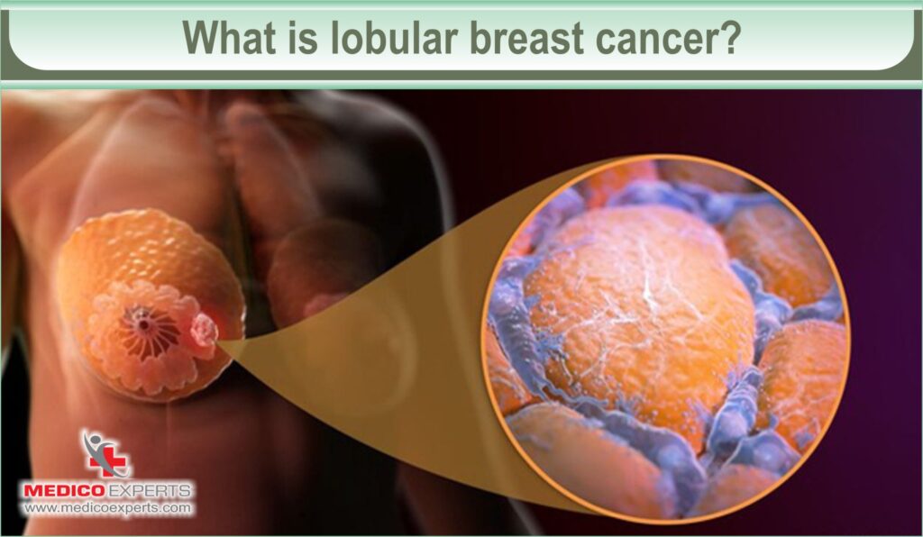 invasive lobular carcinoma