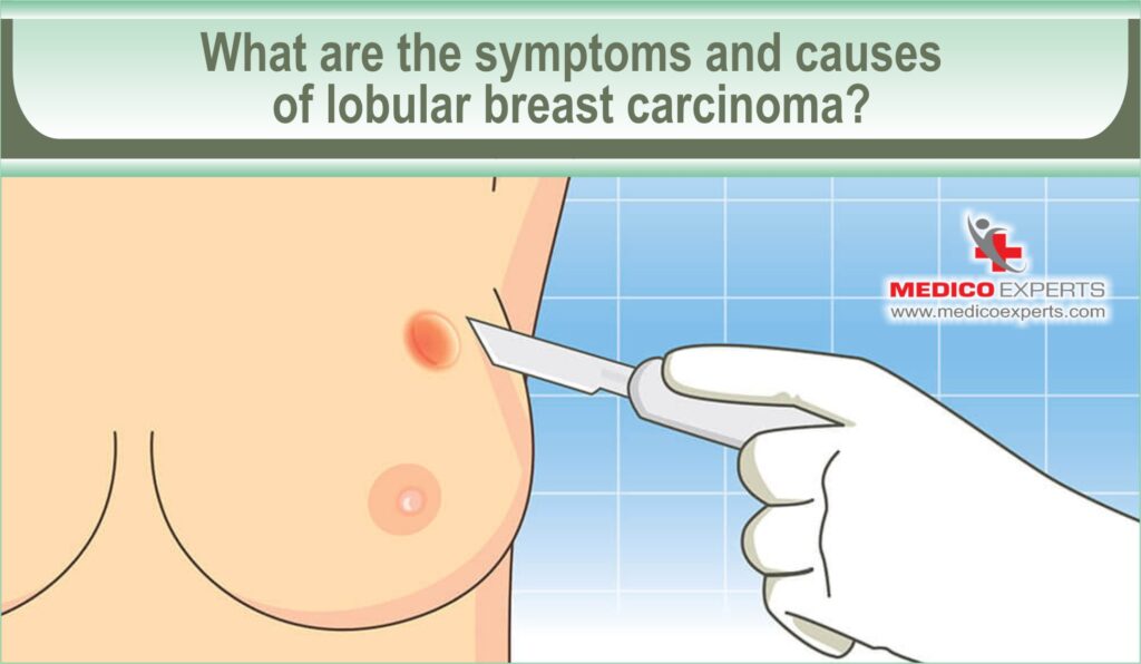 symptoms and causes of lobular breast carcioma