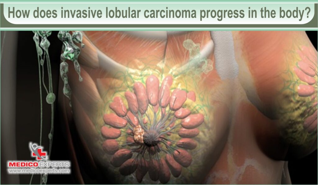 How does invasive lobular carcinoma progress in the body?