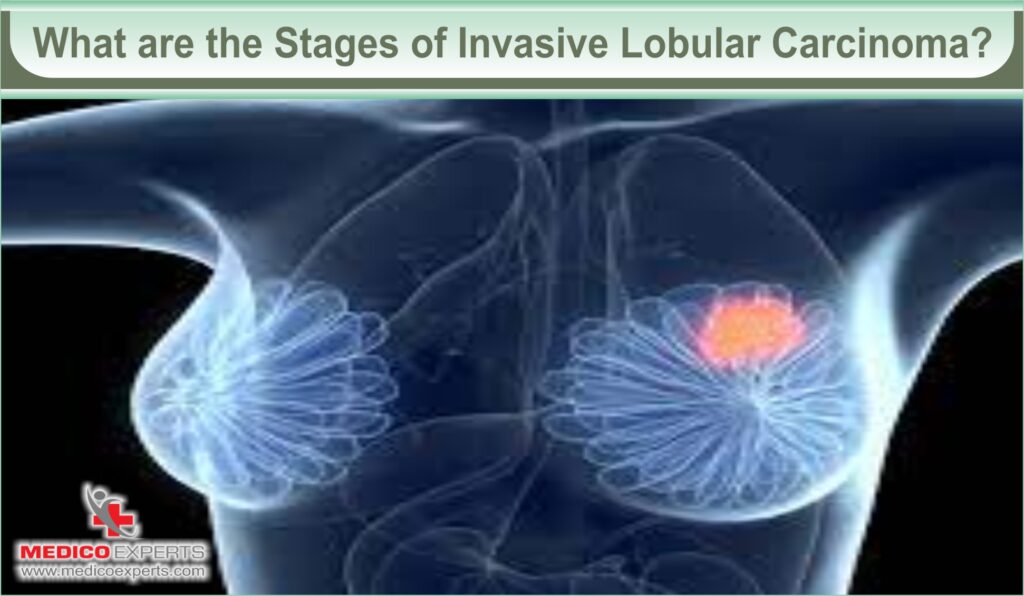 What are the Stages of Invasive Lobular Carcinoma?