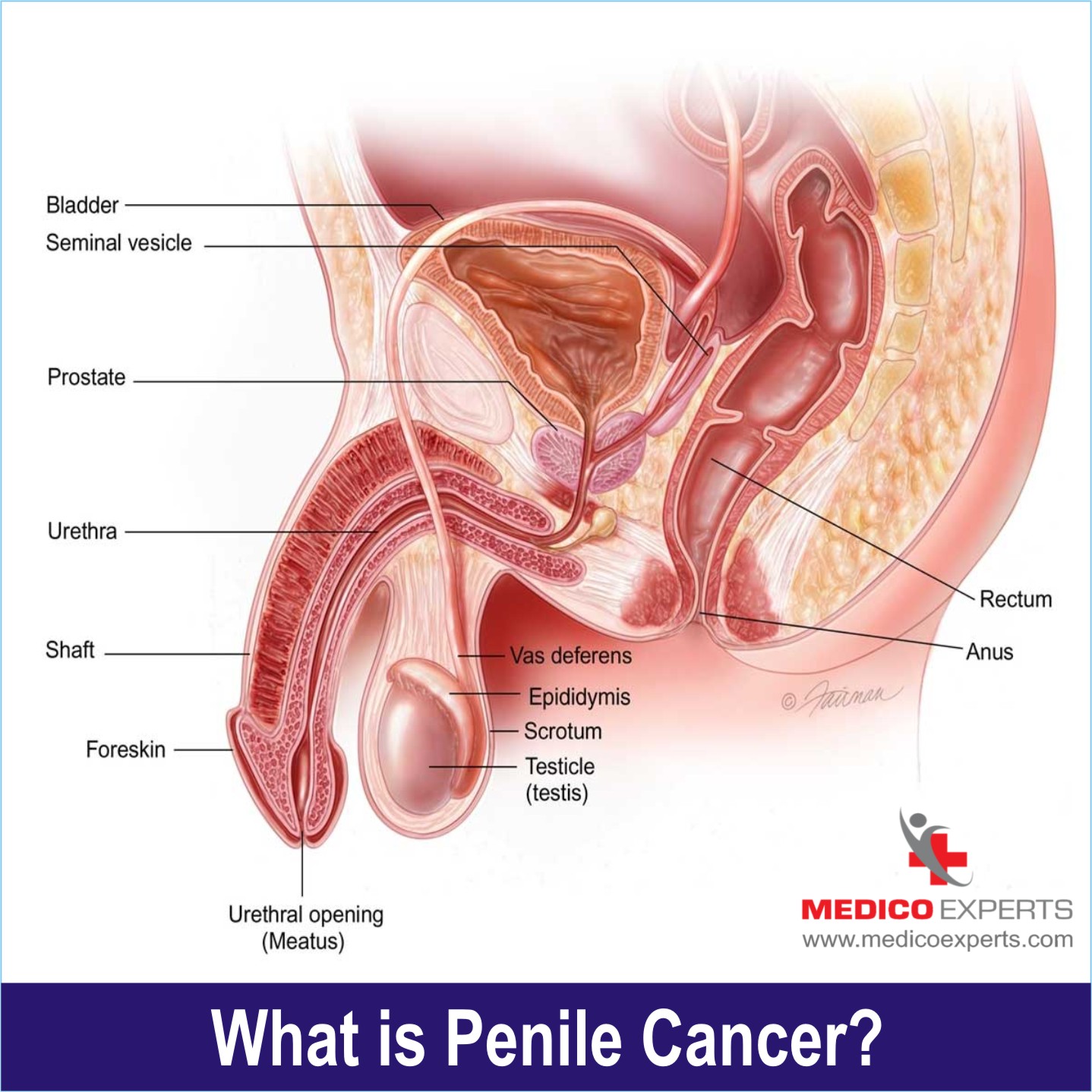 what is penile cancer what is penile cancer