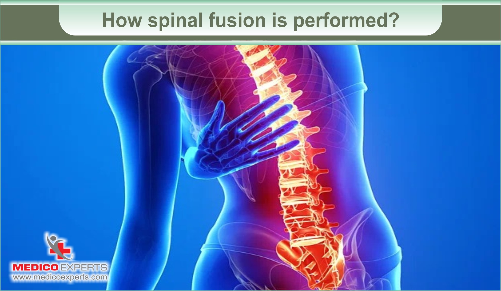 Spinal Fusion Surgery for Back Pain Relief