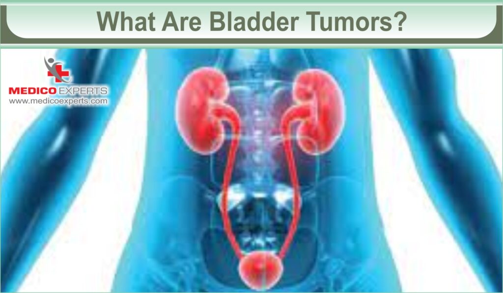What Are Bladder Tumors