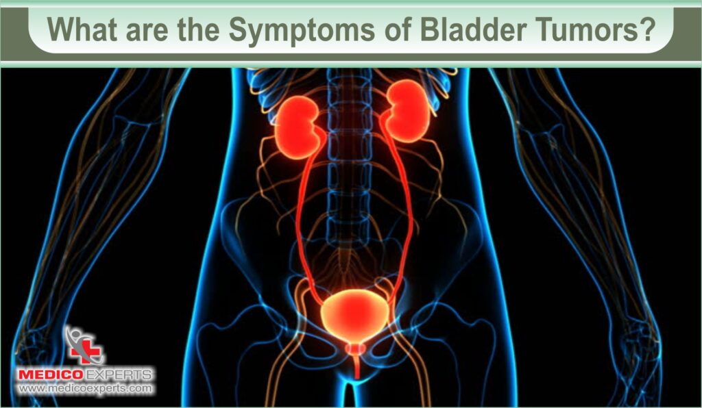 What are the Symptoms of Bladder Tumors