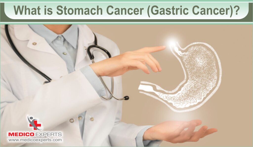 What is Stomach Cancer (Gastric Cancer)