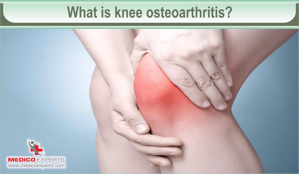 What is knee osteoarthritis