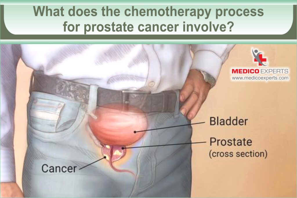 chemotherapy process for prostate cancer