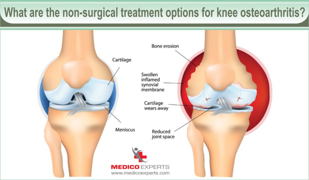 osteoarthritis knee treatment without surgery