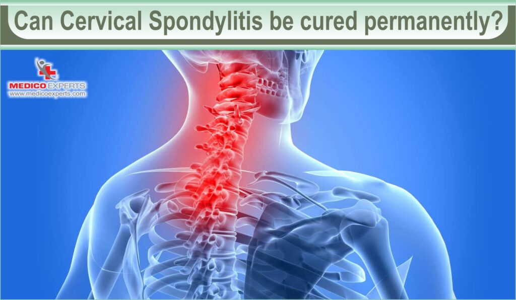 can cervical spondylosis be cured