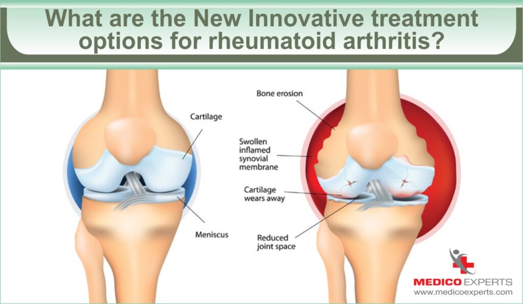 New Innovative treatment options for rheumatoid arthritis