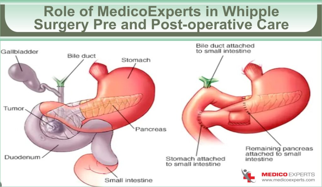 Role of MedicoExperts in Whipple Surgery Pre and Post-operative Care