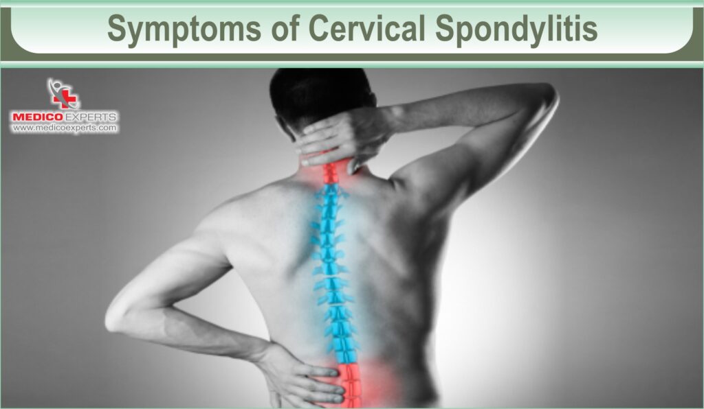 Symptoms of Cervical Spondylitis
