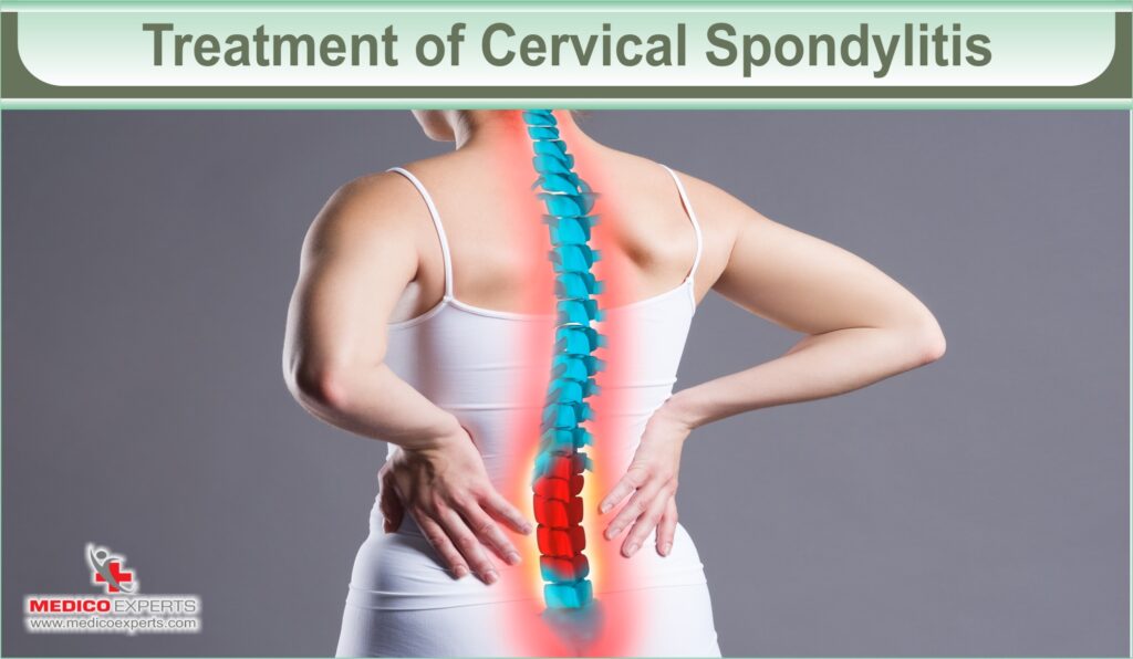 Treatment of Cervical Spondylitis, can cervical spondylosis be cured