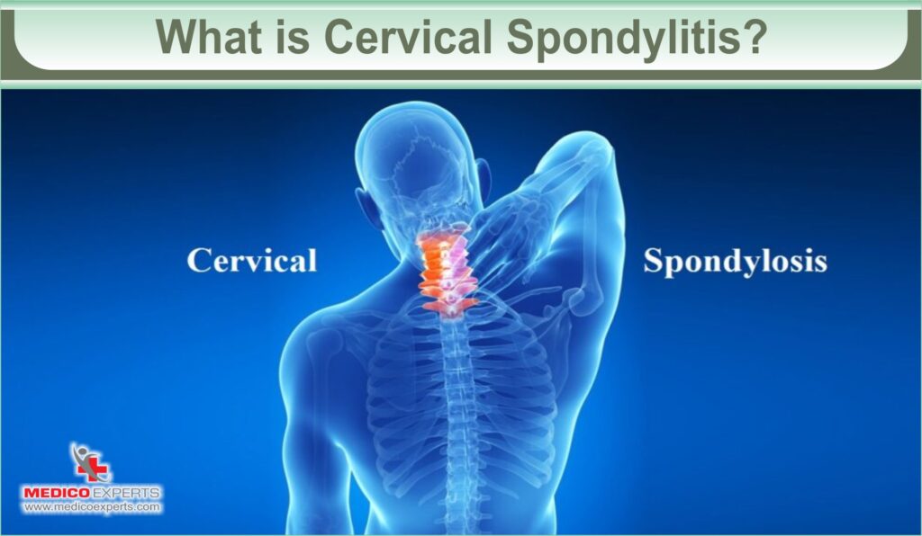 What is Cervical Spondylitis