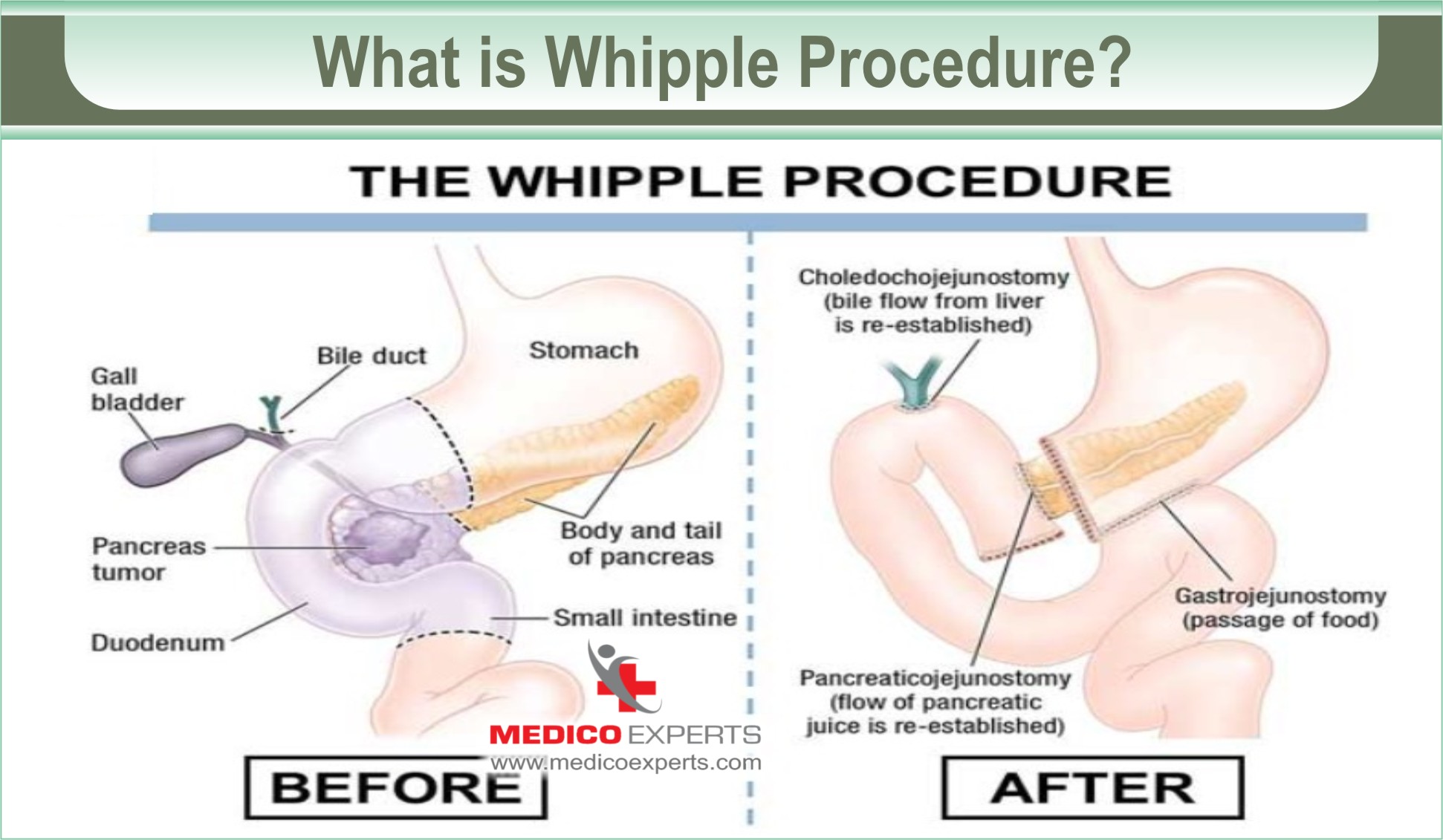 What is Whipple Procedure A Comprehensive Overview