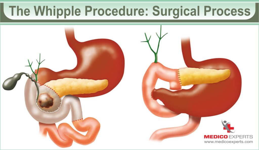 What is Whipple Procedure
