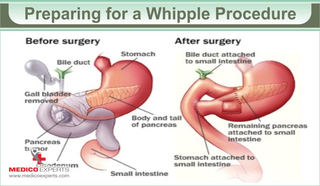 Preparing for a Whipple Procedure