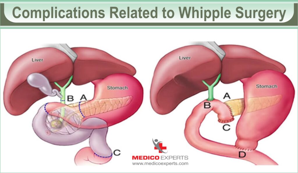 Complications Related to Whipple Surgery